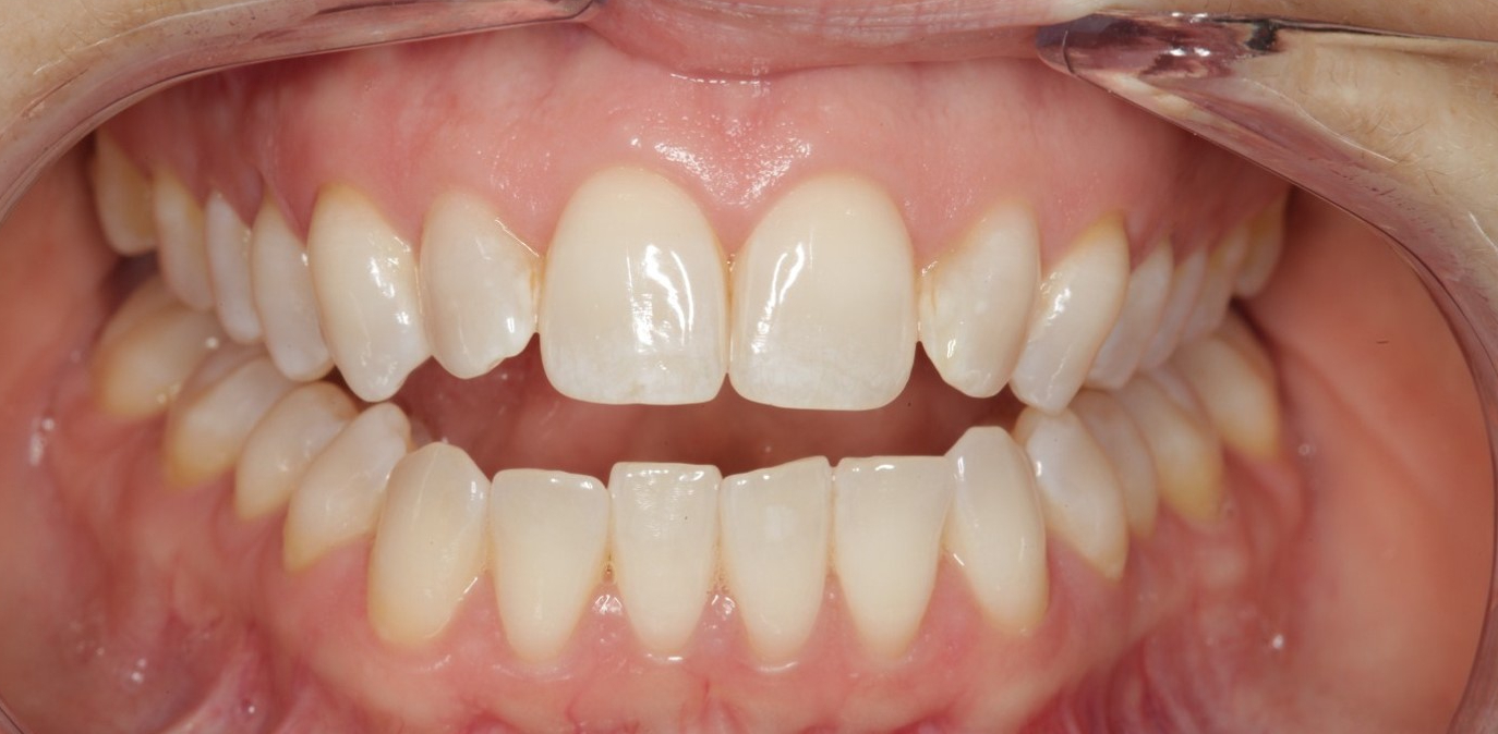 How to Treat an Open Bite Blog Orofacial Myologist in Vaughan